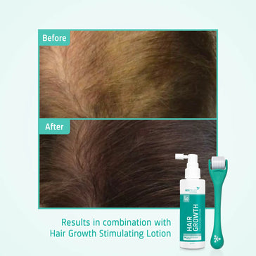 4x Neofollics Haarwachstums-Serum+ kostenloser Scalp Roller 4x Neofollics Haarwachstums-Serum+ kostenloser Scalp Roller - Hairgivers