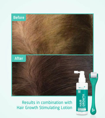 4x Neofollics Haarwachstums-Serum+ kostenloser Scalp Roller 4x Neofollics Haarwachstums-Serum+ kostenloser Scalp Roller - Hairgivers