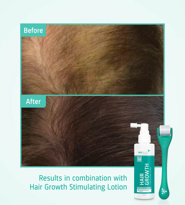 4x Neofollics Haarwachstums-Serum+ kostenloser Scalp Roller