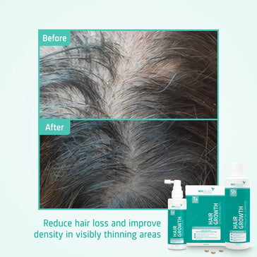 Neofollics Shampoo + Serum + Tabletten Behandlung von mäßigem erblich bedingtem Haarausfall bei Männern - Hairgivers
