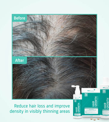 Neofollics Shampoo + Serum + Tabletten Behandlung von mäßigem erblich bedingtem Haarausfall bei Männern - Hairgivers