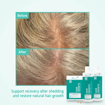 Neofollics Shampoo + Conditioner + Tabletten Behandlung von mäßigem erblich bedingtem Haarausfall bei Frauen - Hairgivers