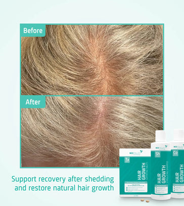 Neofollics Shampoo + Conditioner + Tabletten Behandlung von mäßigem erblich bedingtem Haarausfall bei Frauen - Hairgivers