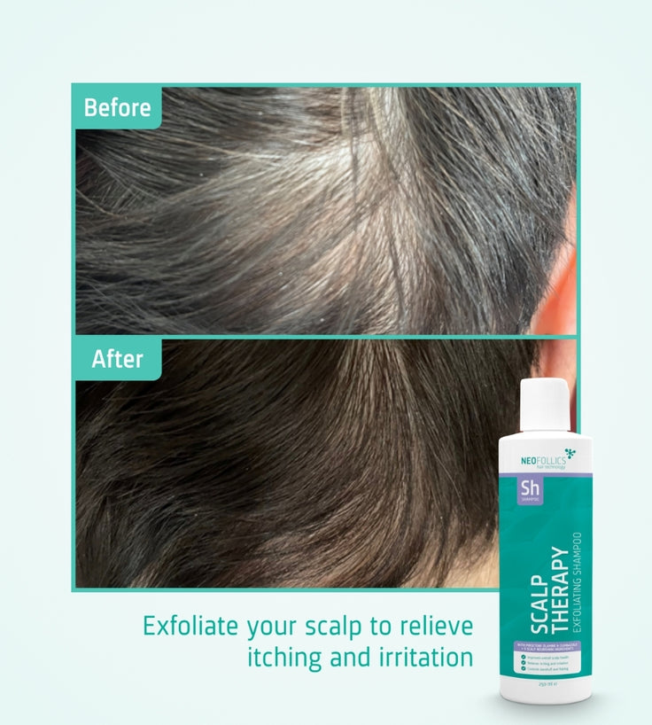 Neofollics Peeling Shampoo
