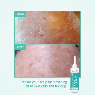 Neofollics Kopfhaut Peeling Serum Neofollics Kopfhaut Peeling Serum - Hairgivers