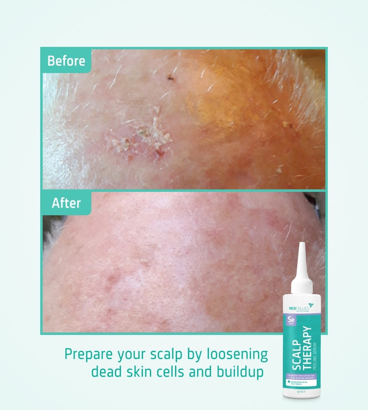 Neofollics Kopfhaut Peeling Serum