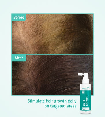 Neofollics Serum gegen Haarausfall (7% Neoxyl) Neofollics Serum gegen Haarausfall (7% Neoxyl) - Hairgivers