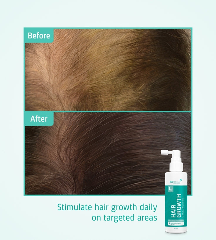 Neofollics Serum gegen Haarausfall (7% Neoxyl)