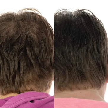 Foligain Shampoo + Serum + Haarwuchs Kapseln (Frau) Foligain Haarwuchsbehandlung (Frau) - Hairgivers