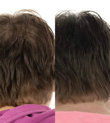 Foligain Shampoo + Serum + Haarwuchs Kapseln (Frau) Foligain Haarwuchsbehandlung (Frau) - Hairgivers