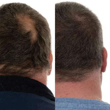 Foligain Shampoo + Serum + Haarwuchs Kapseln (Mann) Foligain Haarwuchsbehandlung (Mann) - Hairgivers