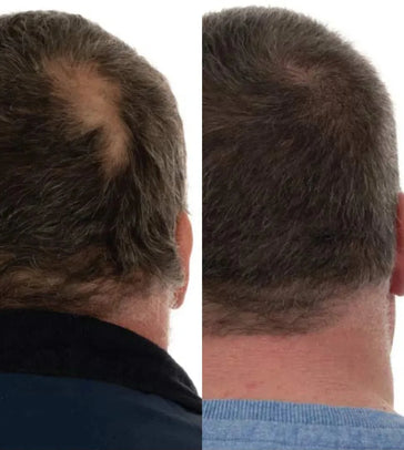 Foligain Shampoo + Serum + Haarwuchs Kapseln (Mann) Foligain Haarwuchsbehandlung (Mann) - Hairgivers