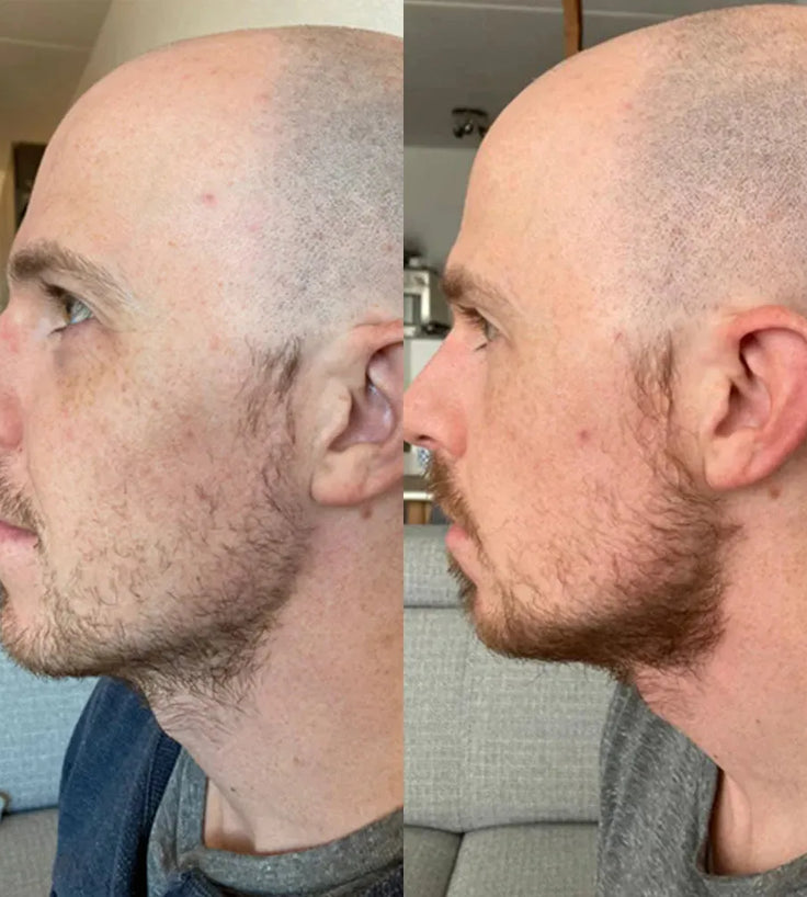 Neofollics Bartserum (7% Neoxyl) - Hairgivers
