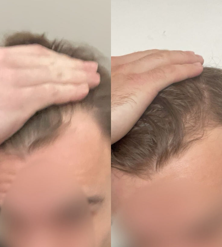 Scandinavian Biolabs Bio-Pilixin Hairline Booster Nachfüllung (3-Pack)