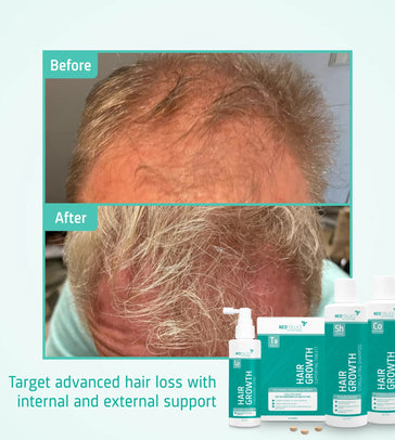 Behandlung von fortgeschrittenem erblich bedingtem Haarausfall bei Männern - Hairgivers