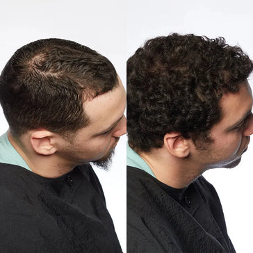 Theradome LH80 PRO Laserhelm - Hairgivers