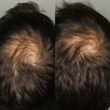 Viviscal Haarwachstum-Tabletten für Männer (1 Monat) - Hairgivers